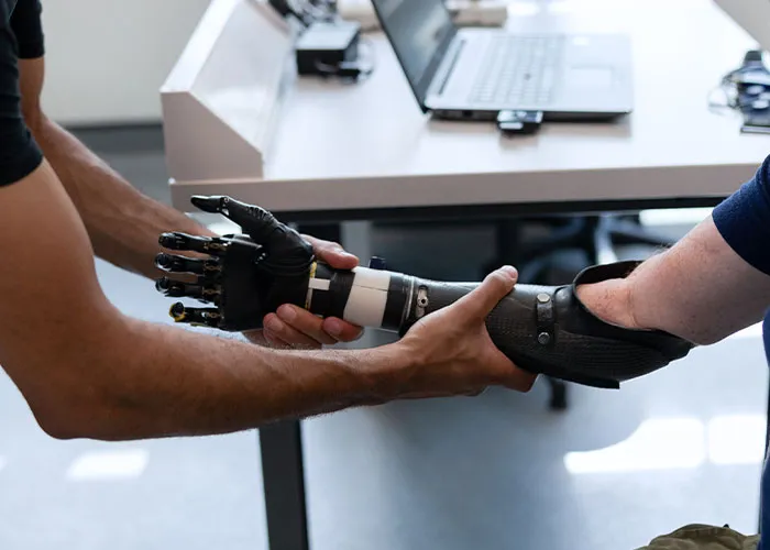 Upper Limb Prosthetics