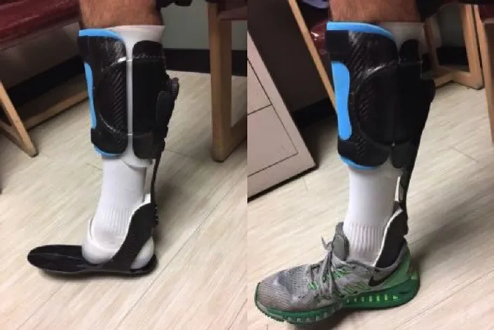 Ankle Disarticulation Prosthesis