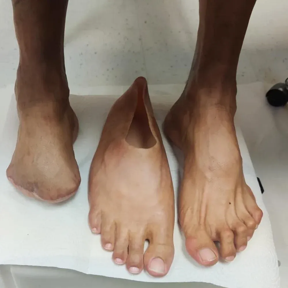 Partial Foot Prosthesis