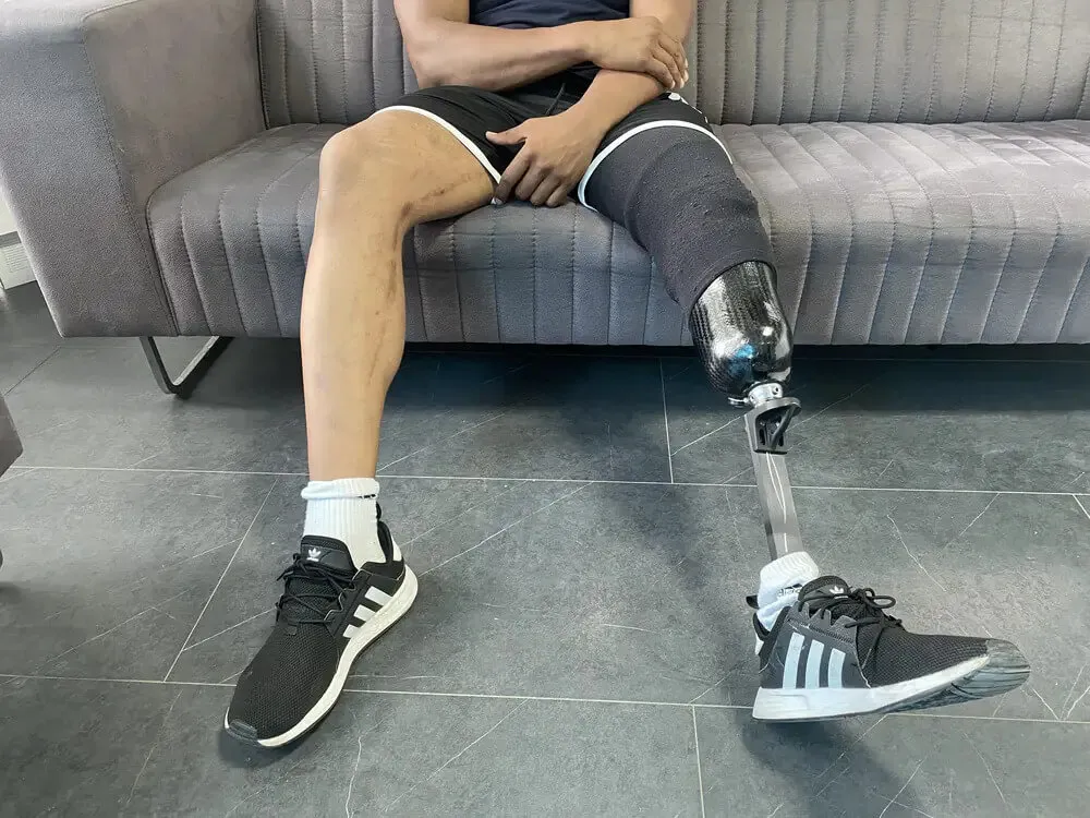 Below-Knee (Transtibial) Prosthesis